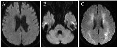 Case report: Adult-onset neuronal intranuclear inclusion disease with an amyotrophic lateral sclerosis phenotype